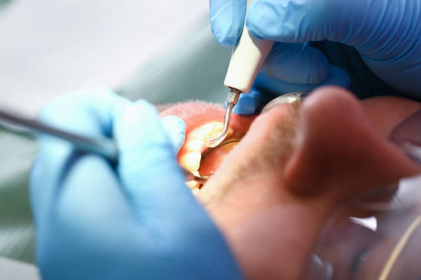 Best Chipped Tooth Repair Near Me  in Fellsburg, PA